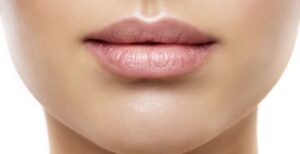 Can You Kiss After Botox Lip Flip