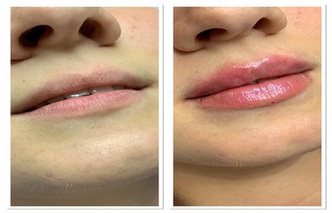 Lip-Flip-Before-And-After