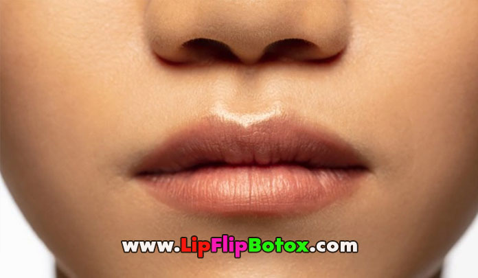 botox-a-lip-flip