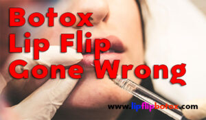 botox-lip-flip-gone-wrong