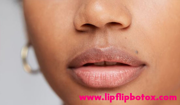 How many units of botox for lip flip