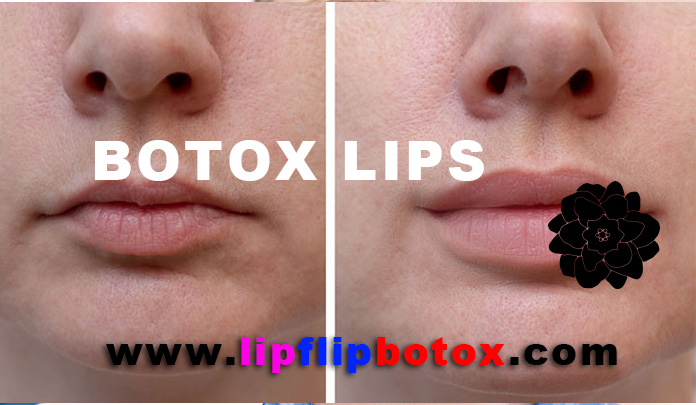 botox lips flip before after