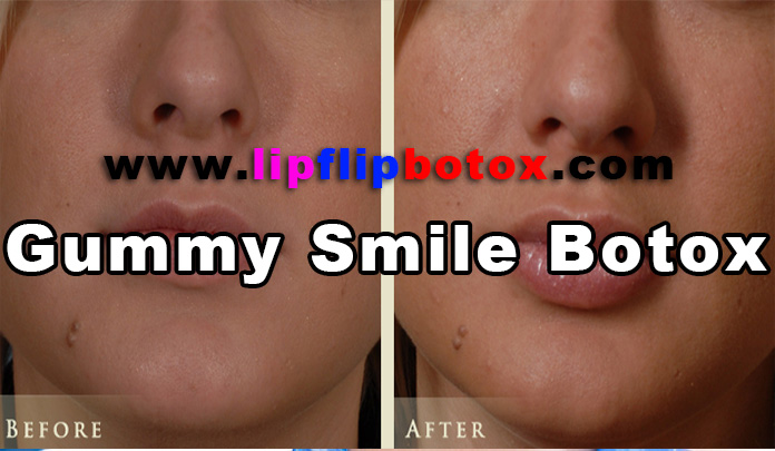 gummy smile botox