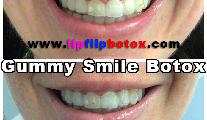 Gummy Smile Botox Lip Flip Botox