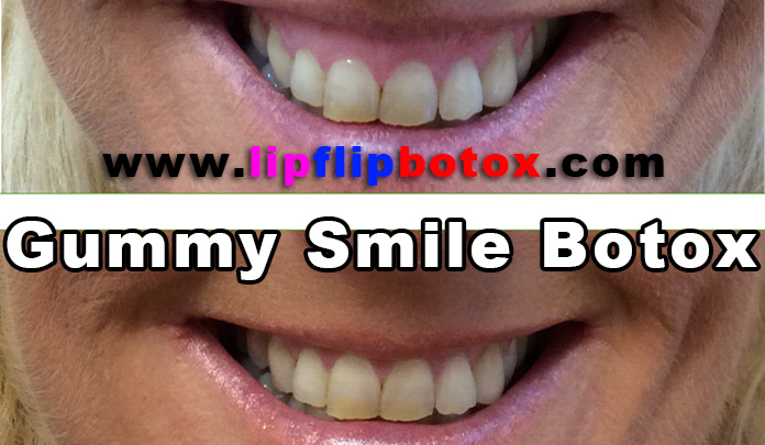 smile gummy botox