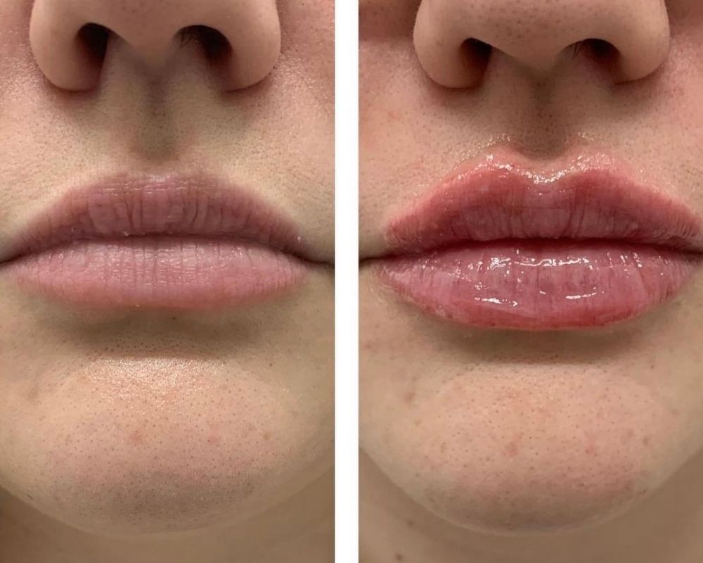 What is Lip Flip Botox